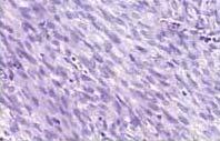 Histopathology NEGATIVE FOR: S-100, a marker for neural crest lineage, positive in nerve sheath cells and melanocytes. LCA, a marker for lymphoma.
