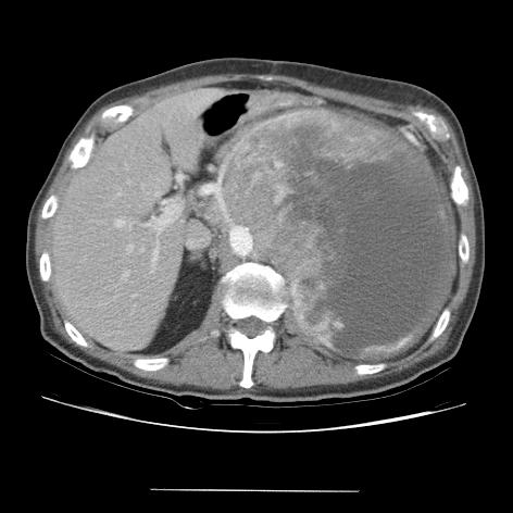 Our Patient: Follow up Abdominal CT CURRENTLY 13 X 20 cm SMA NEARLY