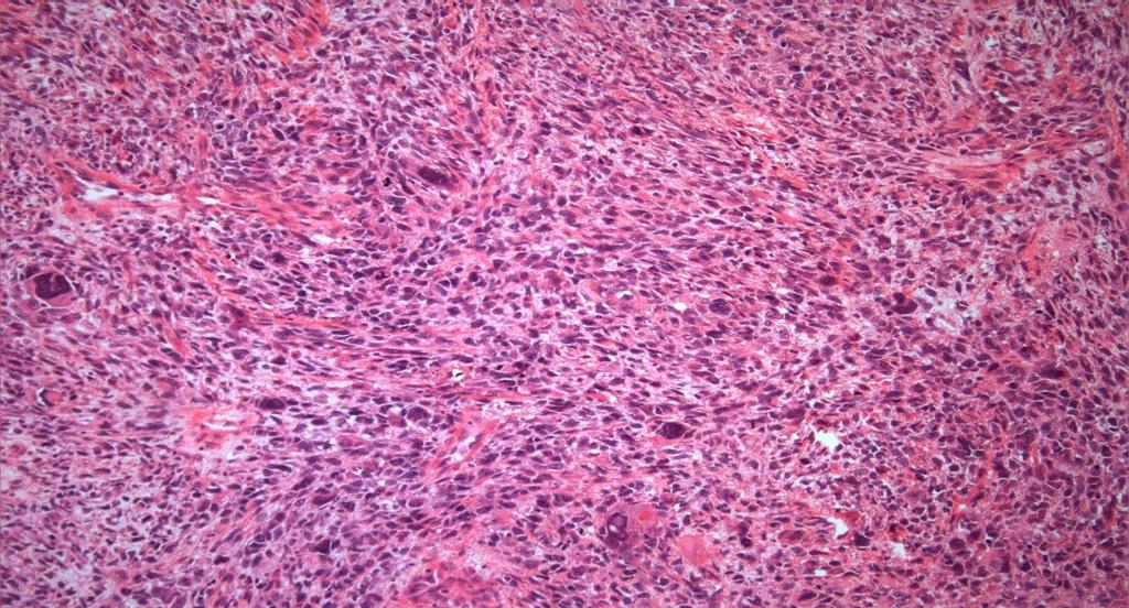 ERMS WITH ANAPLASIA The presence of enlarged, atypical cells with