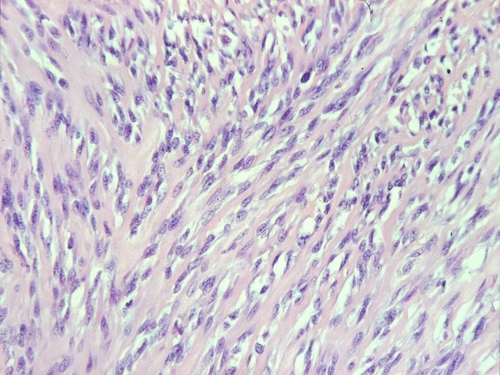 SPINDLE CELL/SCLEROSING RMS Densely arrayed whorls or fascicles of spindle cells constitute the spindle cell variant of embryonal rhabdomyosarcoma.