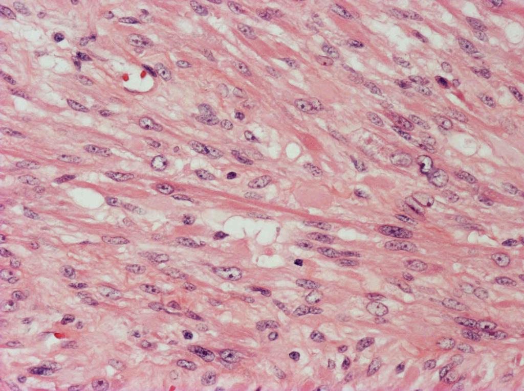 SPINDLE CELL/SCLEROSING RMS Densely arrayed whorls or fascicles of spindle cells constitute the spindle cell variant of embryonal rhabdomyosarcoma.