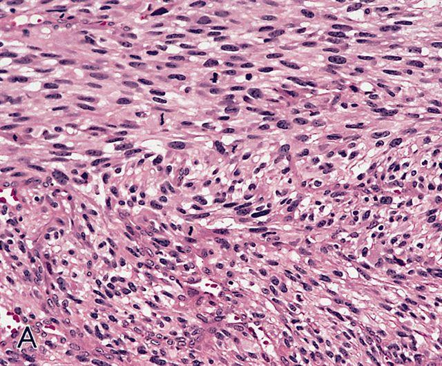 SPINDLE CELL/SCLEROSING RMS Spindle cell/sclerosing RMS is an uncommon variant of RMS that has spindle cells morphology.