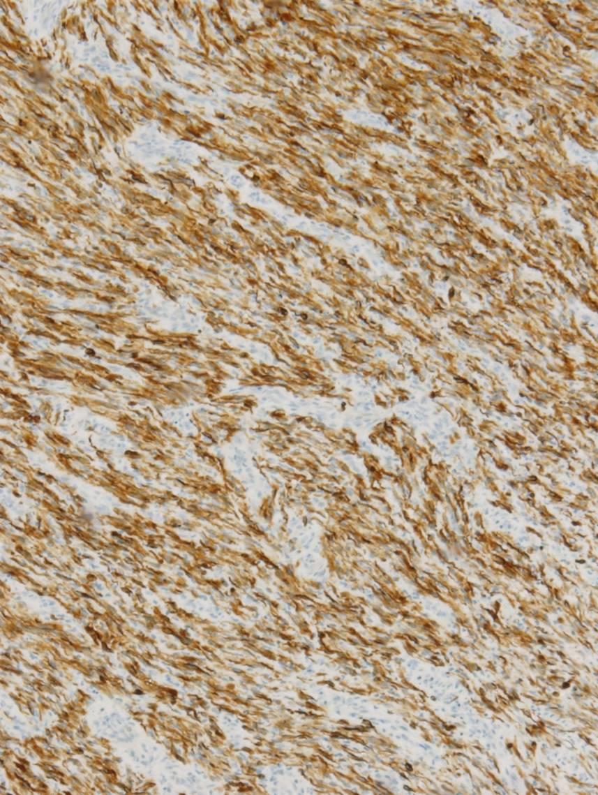 Immunohistochemical Findings Marker Vimentin 3/3 Smooth muscle actin 3/3 Muscle specific actin 3/3 Desmin 3/3