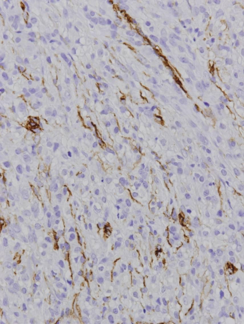 Immunohistochemical Findings Marker Vimentin 3/3 Smooth muscle actin 3/3 Positive Muscle specific actin 3/3*