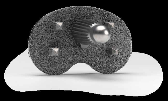 Regenerex Porous Titanium Construct Clinically proven material, 1 advanced porous technology