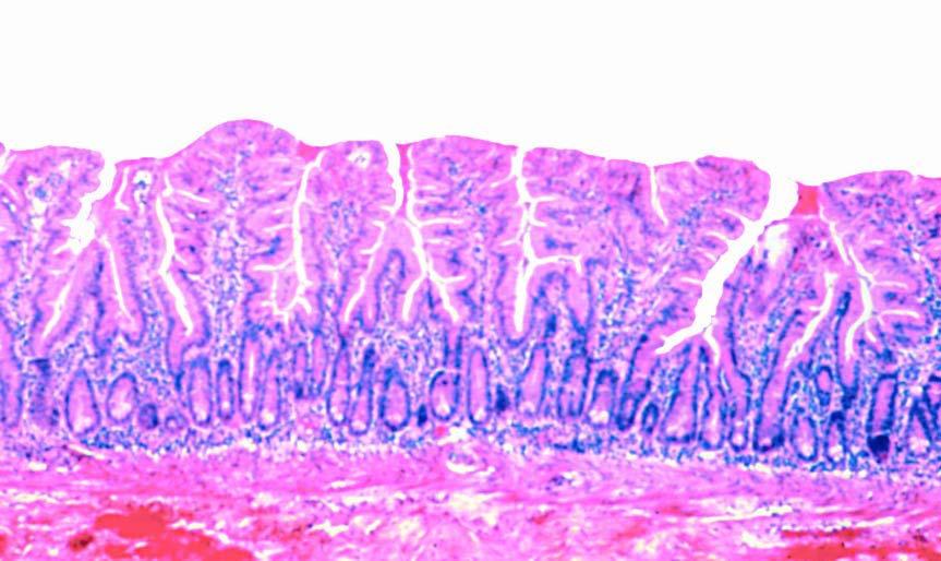 Protozoa: Giardia intestinalis Pathogenesis: Trophozoite stage induces malabsorption of fats.