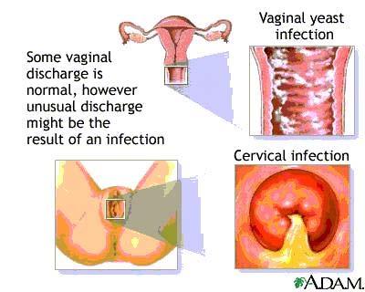 Causing persistent vaginitis, complain of itching and burning sensation; vaginal wall is injected, tender,