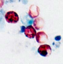 CRYPTOSPORIDIUM PARVUM Cryptosporidiasis is often the cause of profuse watery diarrhoea in AIDS patients.