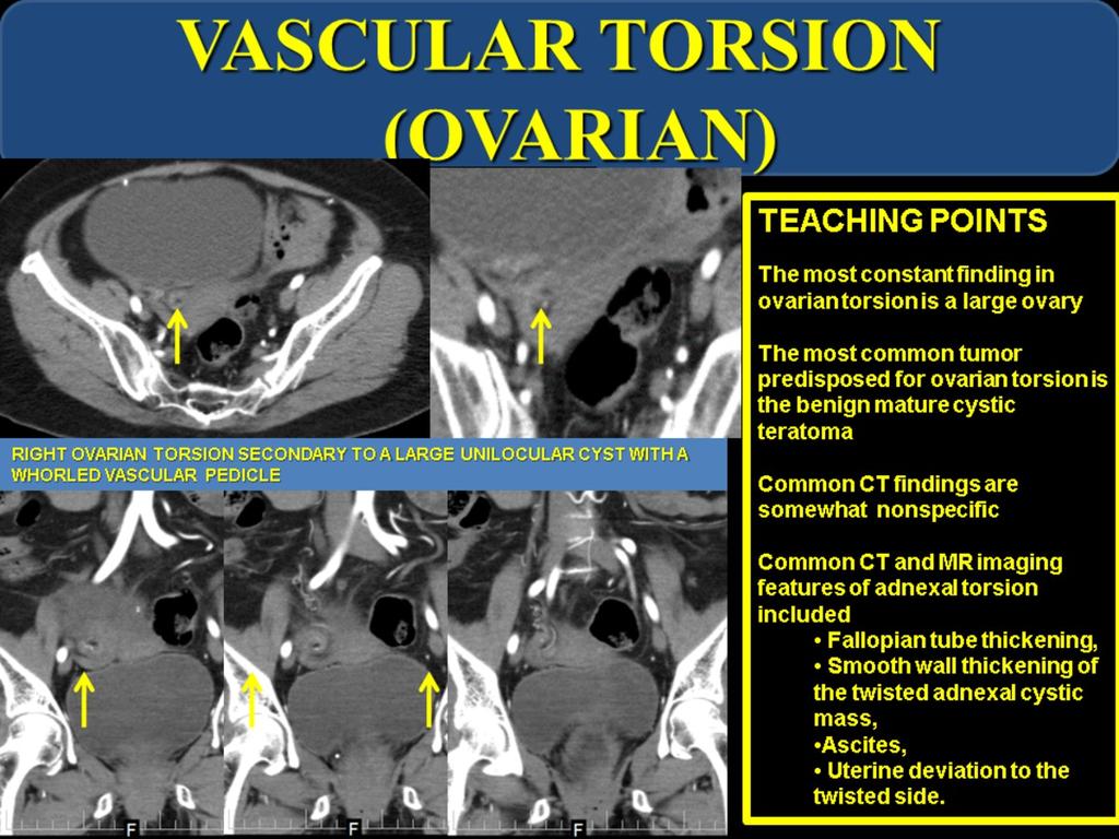Fig. 12: Ovarian
