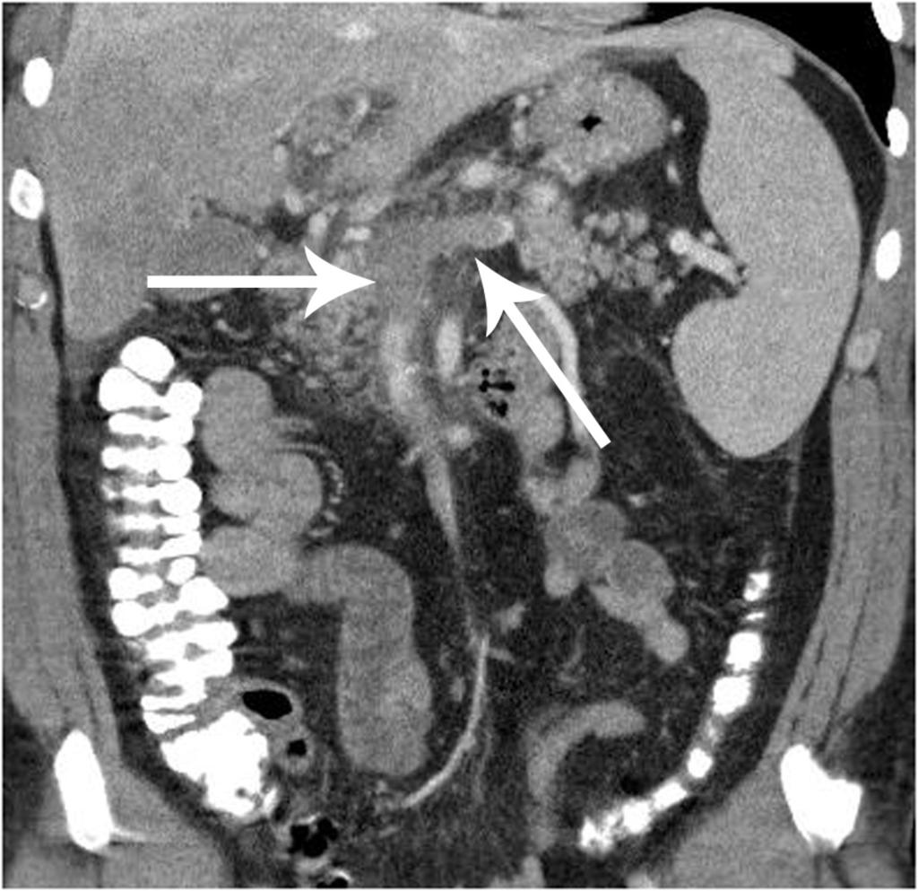 Fig. 8: Splenic, portal and superior mesenteric vein thrombosis at unenhanced CT axial and coronal images on standard abdominal windows
