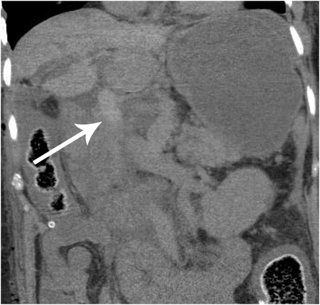 Fig. 9: Portal vein thrombosis in a patient day 1 post-liver transplant at axial