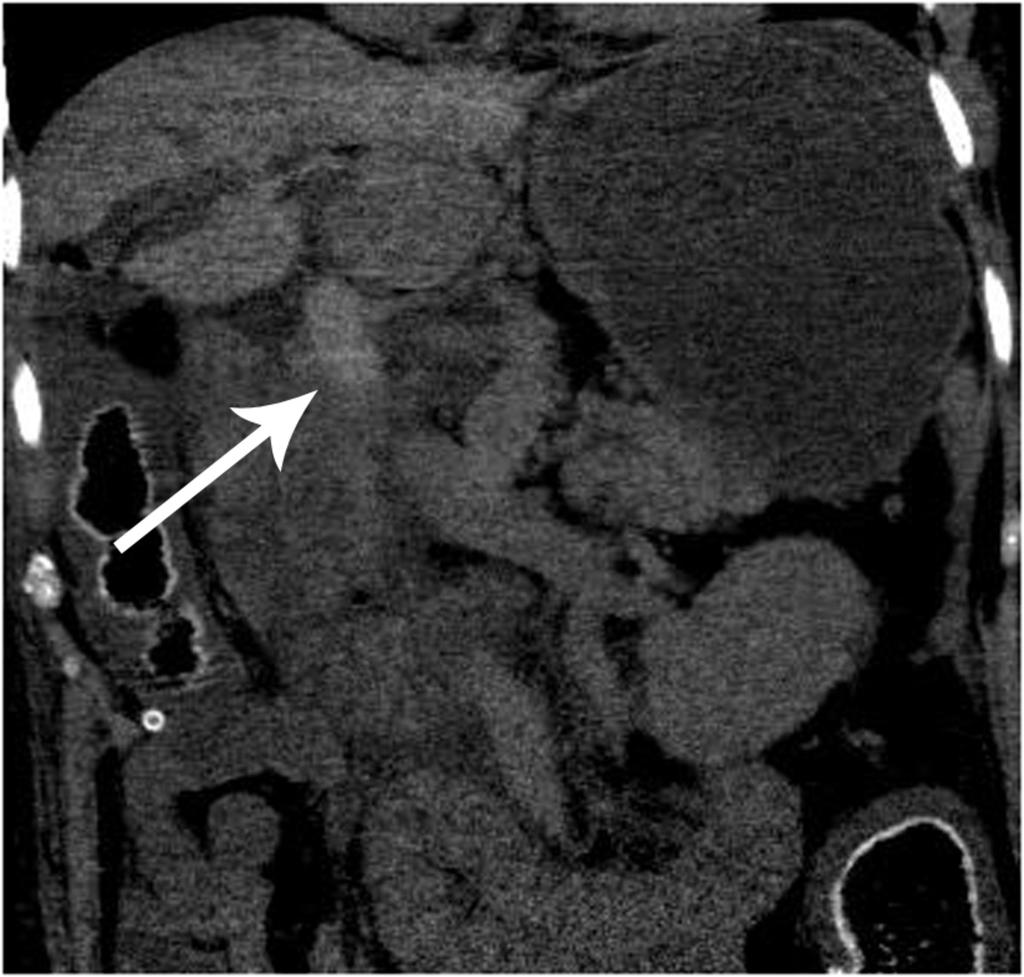 Fig. 10: Portal vein thrombosis in a patient day 1 post-liver transplant at axial
