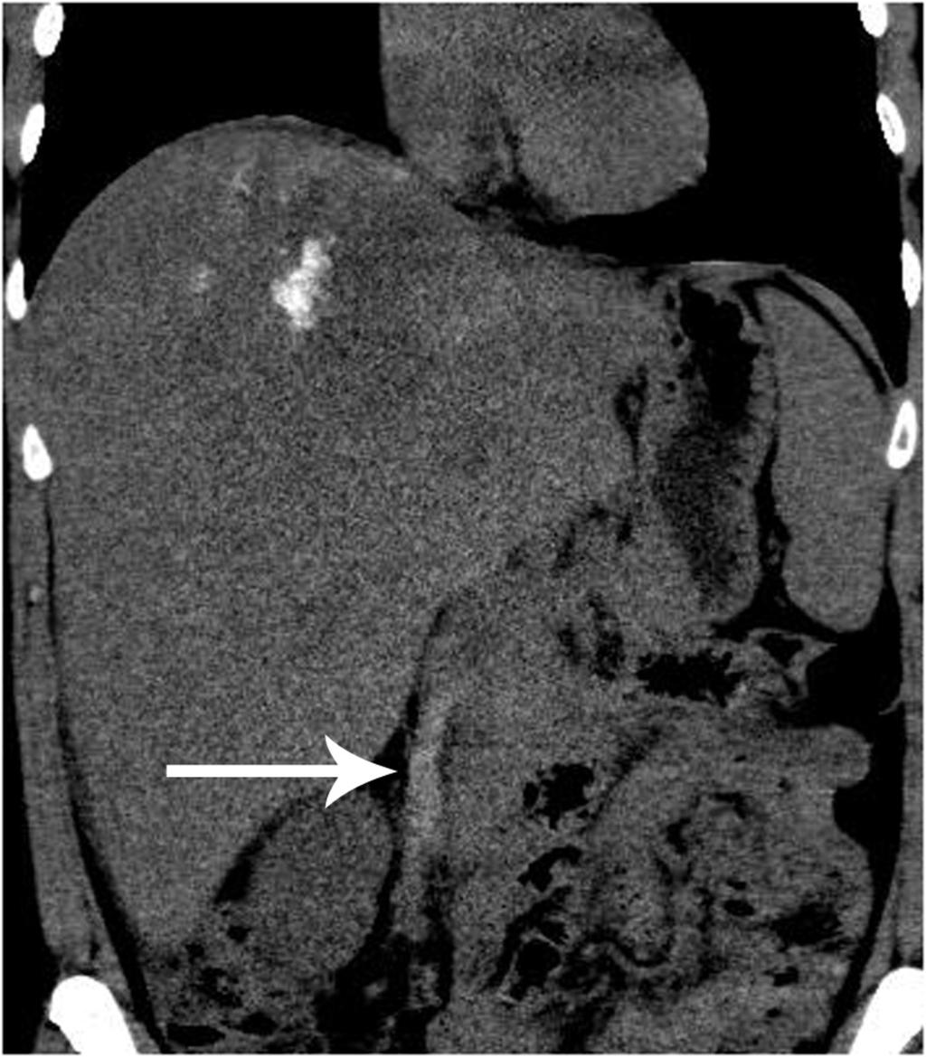 Fig. 12: Right gonadal vein thrombosis in a patient treated for hepatoma on coronal unenhanced CT standard abdominal