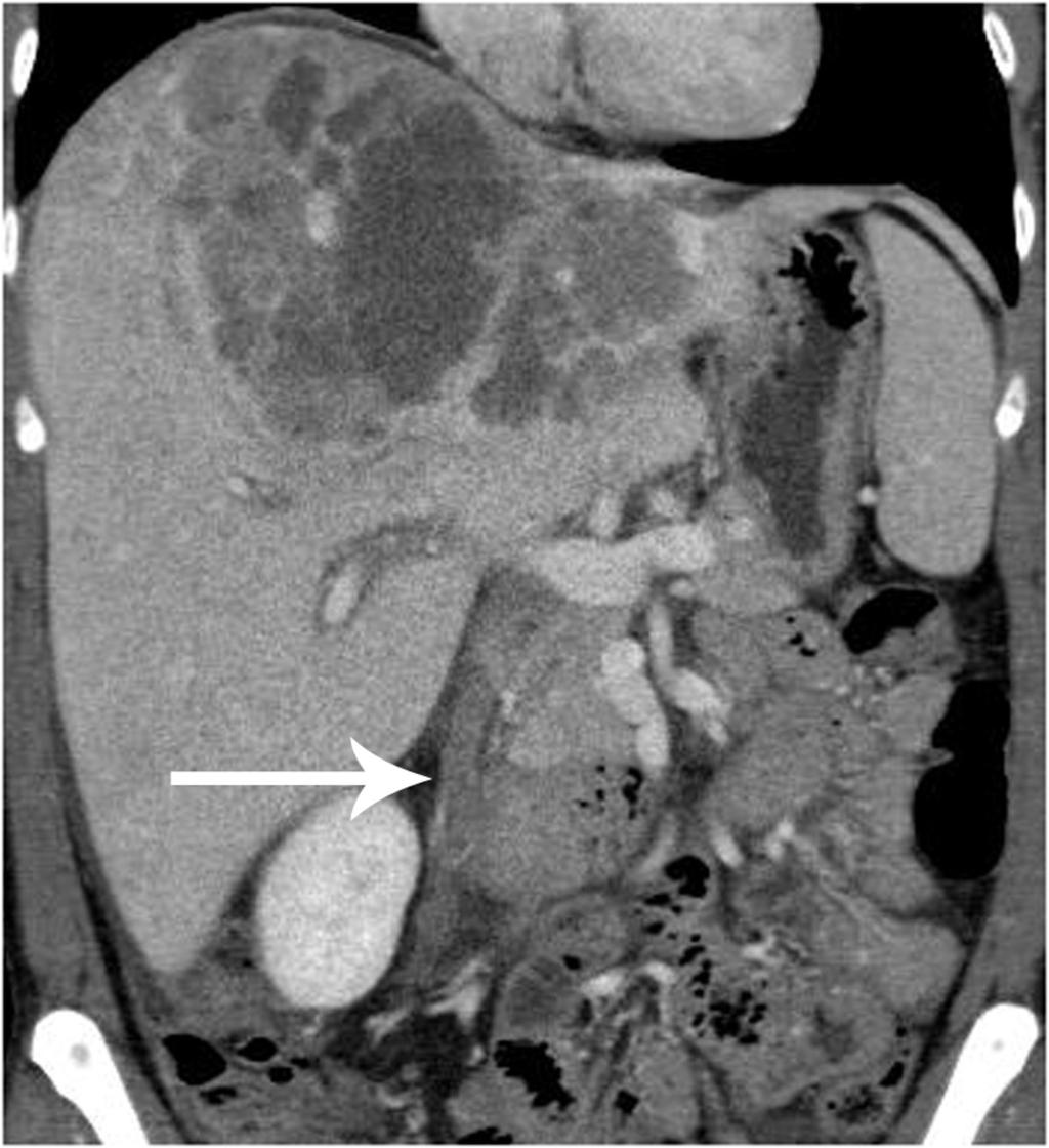 Fig. 13: Right gonadal vein thrombosis in a patient treated for hepatoma on coronal unenhanced CT standard abdominal