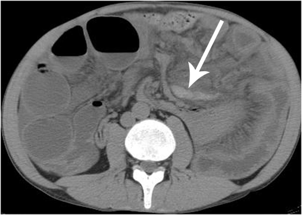 Fig. 14: SMV branch thrombosis in a patient presenting with closed loop small bowel obstruction and ischaemic small bowel confirmed on
