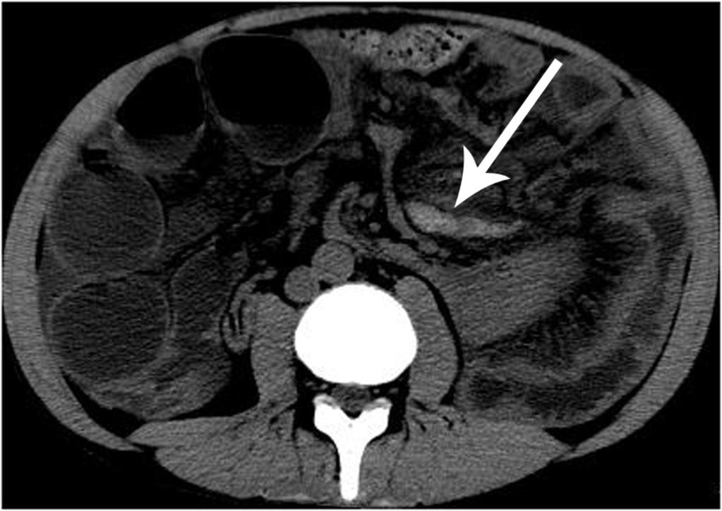 Fig. 15: SMV branch thrombosis in a patient presenting with closed loop small bowel obstruction and ischaemic small bowel confirmed on