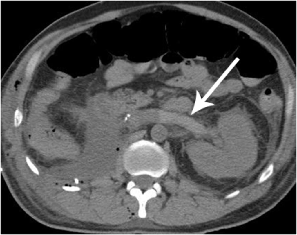 Fig. 16: Left renal vein, and IVC and bilateral common iliac, and left internal and external iliac vein thromboses in a patient post-ivc
