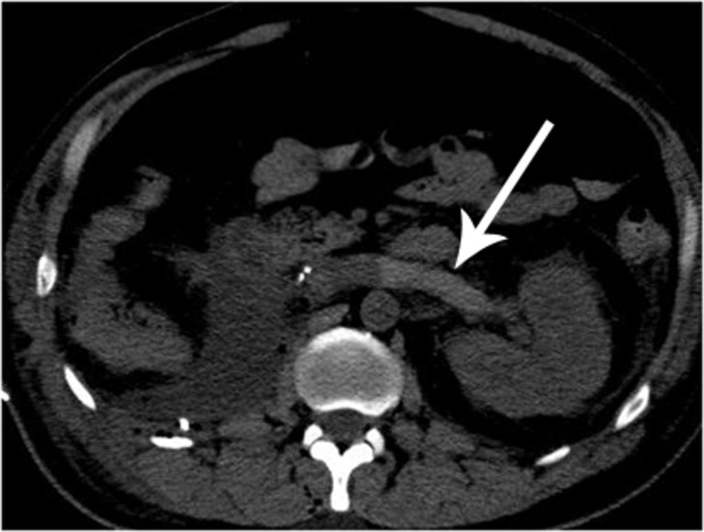 Fig. 17: Left renal vein, and IVC and bilateral common iliac, and left internal and external iliac vein thromboses in a patient post-ivc