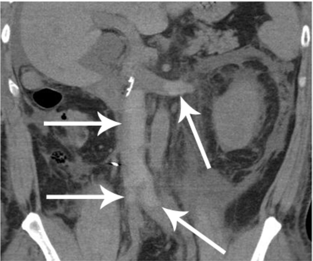 Fig. 18: Left renal vein, and IVC and bilateral common iliac, and left internal and external iliac vein thromboses in a patient post-ivc