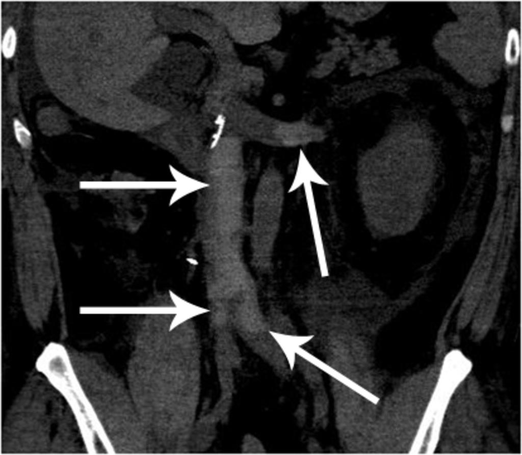 Fig. 19: Left renal vein, and IVC and bilateral common iliac, and left internal and external iliac vein thromboses in a patient post-ivc