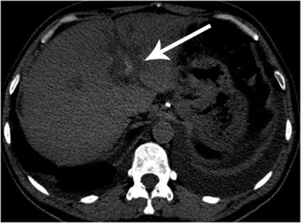 Fig. 2: Left portal vein thrombosis at unenhanced CT on standard