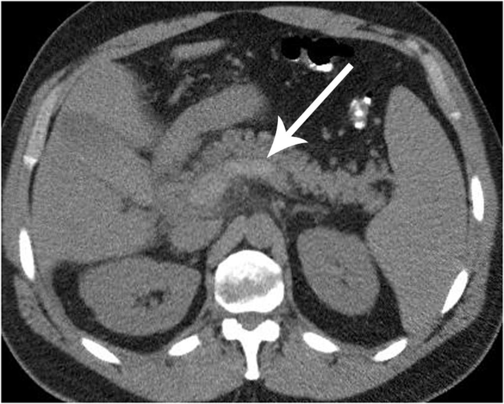 Fig. 3: Splenic, portal and superior mesenteric vein thrombosis at unenhanced CT axial and coronal images on standard abdominal windows