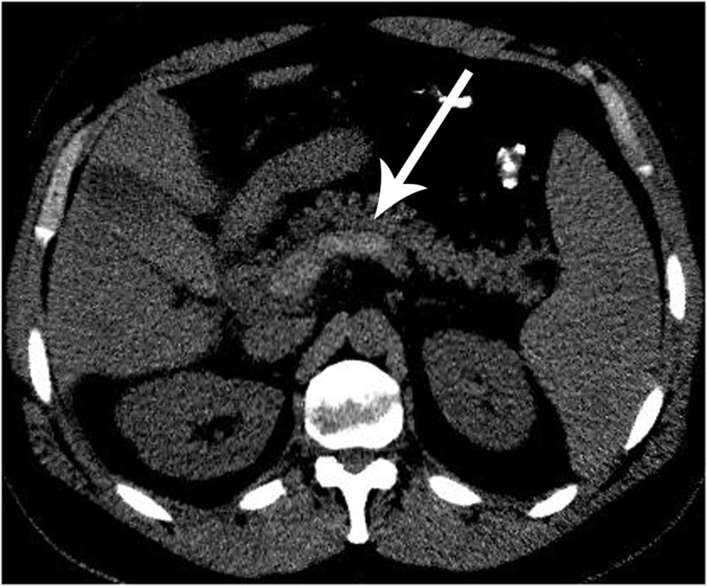 Fig. 4: Splenic, portal and superior mesenteric vein thrombosis at unenhanced CT axial and coronal images on standard abdominal windows