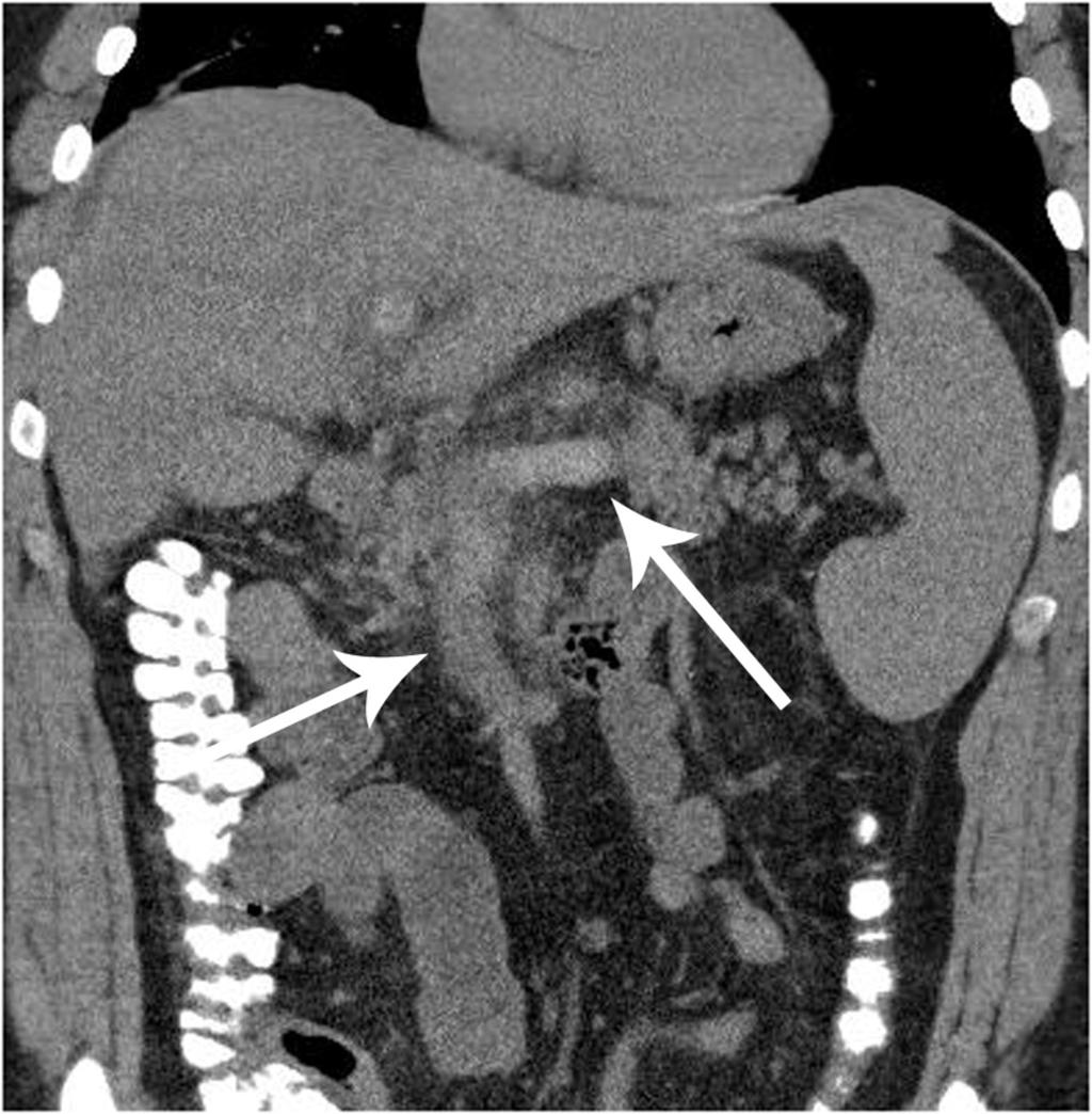 Fig. 5: Splenic, portal and superior mesenteric vein thrombosis at unenhanced CT axial and coronal images on standard abdominal windows
