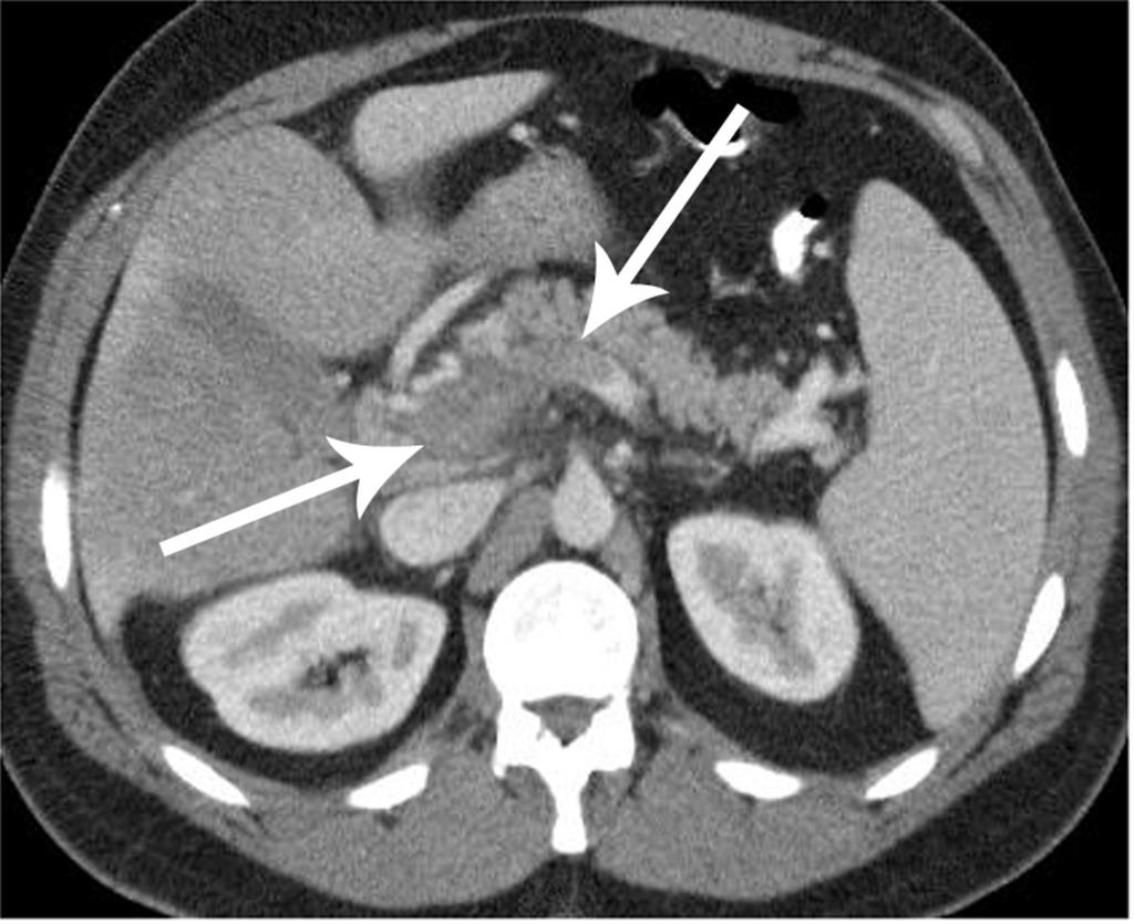 Fig. 7: Splenic, portal and superior mesenteric vein thrombosis at unenhanced CT axial and coronal images on standard abdominal windows