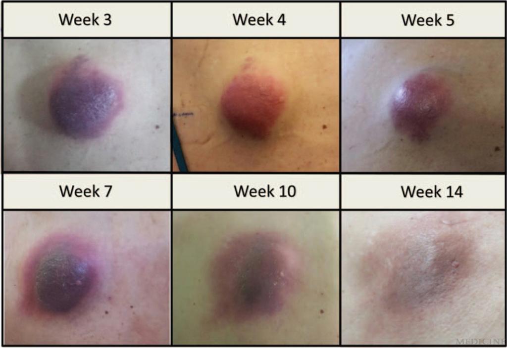 by week of treatment.