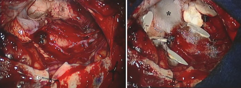 272 H. Mtsumur et l. Fig. 2 Opertive findings of the tumor resection. Opertive findings showing the tumor resected cvity efore () nd fter () occlusion of the ventricle nd implnttion of 6 wfers.