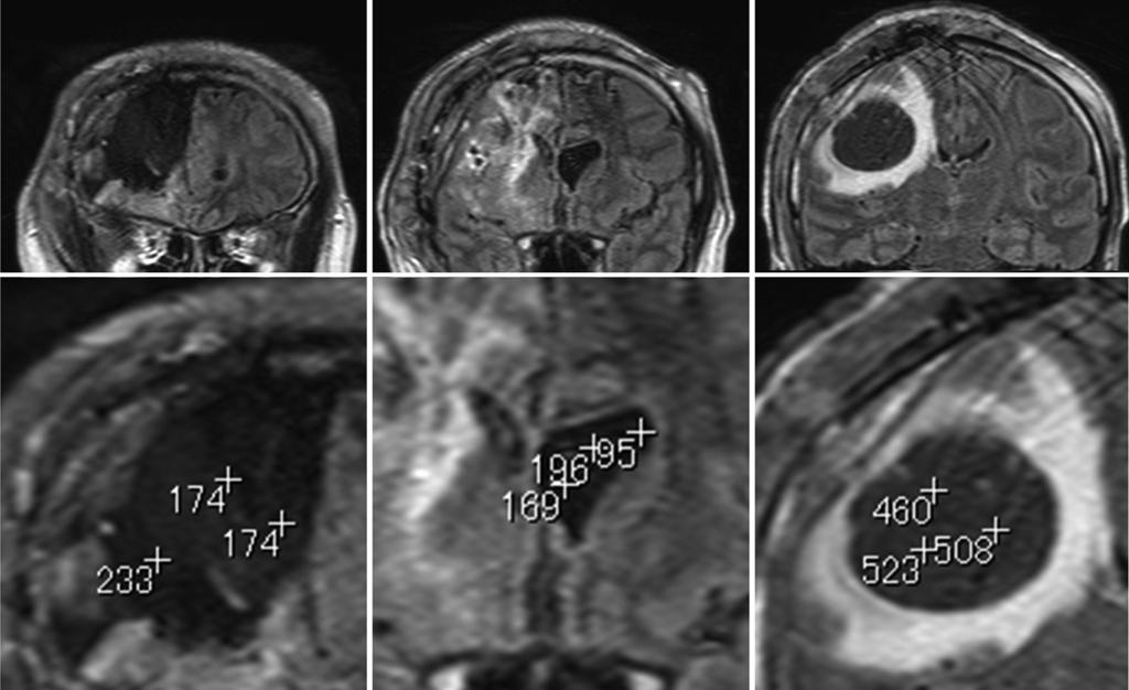 Symptomtic Remote Cyst fter BCNU Wfer Implnttion c d e f 273 Fig. 4 Intensity difference of tumor resected cvity, lterl ventricle, nd cyst on fluid-ttenuted inversion recovery (FLAIR) imges.