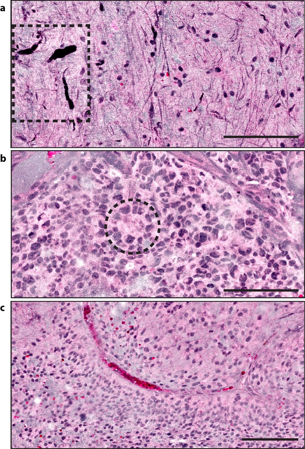 SUPPLEMENTARY INFORMATION Figure S2: SRH of pediatric posterior fossa tumors.