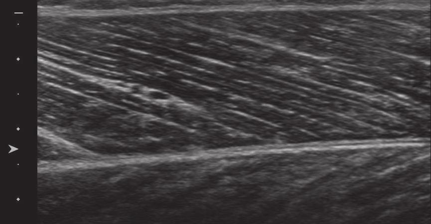 38 JPFSM: Ema R, et al. Fig. 1 An example of an ultrasound image of a pennate muscle. White straight line indicates a fascicle, and θ shows pennation angle. a consensus has not been reached.