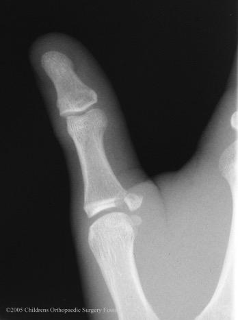 5. Salter-Harris III fracture of thumb Pediatric gamekeeper s thumb UCL avulsion