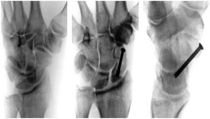 fractures Faster healing? Bond et al.