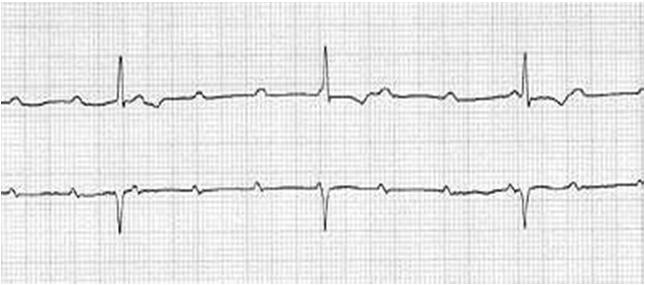 intermittently 3 RD DEGREE HEART