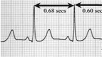 ARRHYTHMIA Palpitations +/- syncope (Race,Flutters, Beeps and Thumps)
