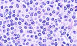 Plasmacytoid Histologic Features
