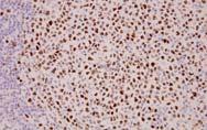 portion of duodenum CD10+, BCL2+, BCL6+,