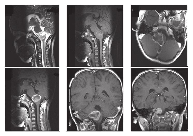 1898 QI et al: IDH MUTATION AND TUMOR LOCATION/MRI FEATURES IN ASTROCYTIC NEOPLASMS Table I. Main clinical characteristics.