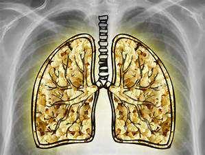 Diacetyl- popcorn lung (bronchiolitis obliterans) Safer than