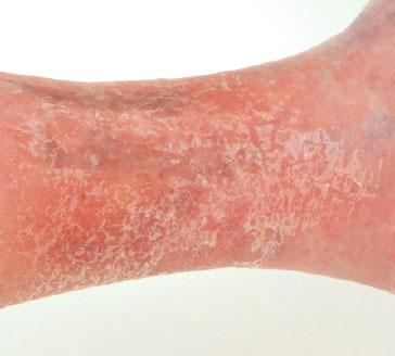 Recommended management of eczema in older patients Victoria Sherman MA, MRCP and Daniel Creamer BSc, MD, FRCP Our series Prescribing in older people gives practical advice for successful management