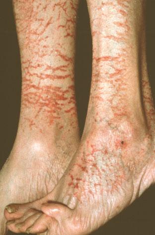 SPL dermatitis to topical preparations. There should be a low threshold for referring patients to secondary care. Further reading BAD guidelines for the management of atopic eczema. www.bad.org.