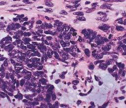 Snyder et al / CYTOLOGY OF CARCINOSARCOMA OF UTERUS A B C Image 1 (Case 2) Carcinosarcoma.