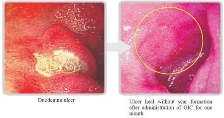 Healed Duodenal Ulcer Distribution A: Approved for public release;