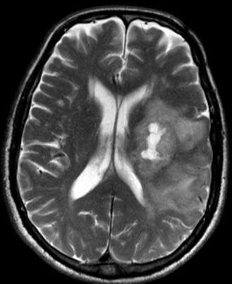 MRI Shows Enhancing and Necrotic