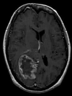 enhancing lesions on MRI, noted immediately after the end