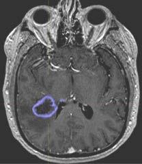 MRI C 2-normal fit D 2.