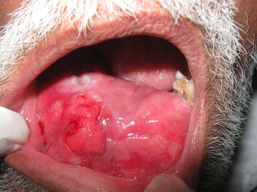 3 Journal of Research and Practice in Dentistry Figure 1: Intra Oral Photograpgh of Swelling with Labial, Buccal And Lingual Cortical Expansions Figure 2: Opg Showing Honey Comb